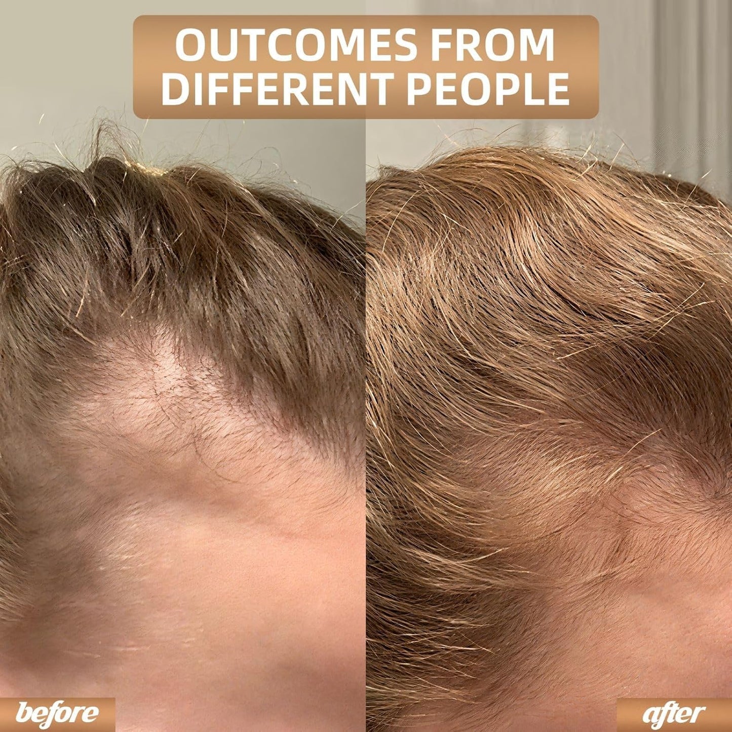 Cordless Red Light Therapy Cap For Hair Growth