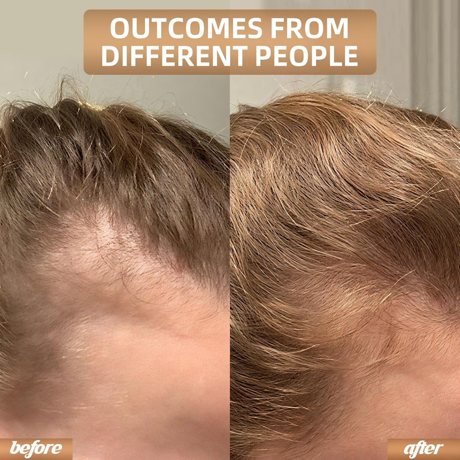 Cordless Red Light Therapy Cap For Hair Growth